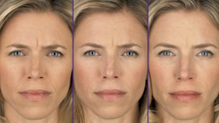 Progression of Botox